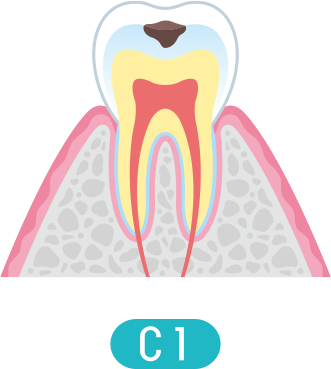 C1の症状