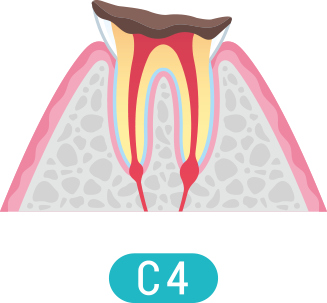 C４の症状