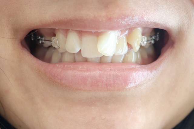 矯正歯科の歯並びの改善方法