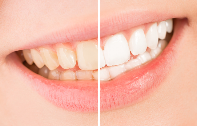 ポリリン酸の歯のホワイトニングにおける効果とは何でしょうか？