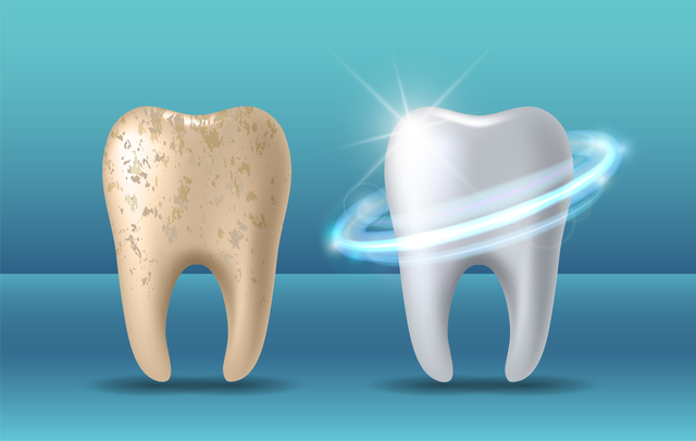歯のホワイトニングの種類