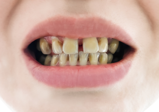 歯の汚れの種類